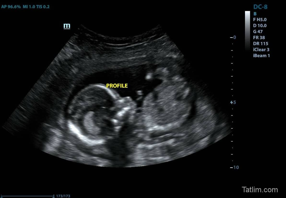 hamilelikte-29-hafta-ultrason-goruntusu-1