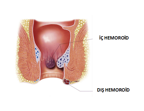 hemoroid